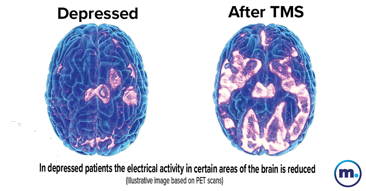 Transcranial Magnetic Stimulation Therapy In St George Ut